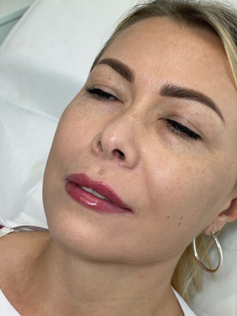 What Is the Best Age for Lip Fillers? A UK Perspective